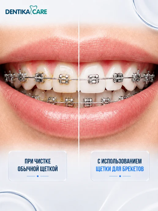 Dentika Care Монопучковая щетка зубная для брекетов монопучок, набор 3шт, 4 шт, фото 4
